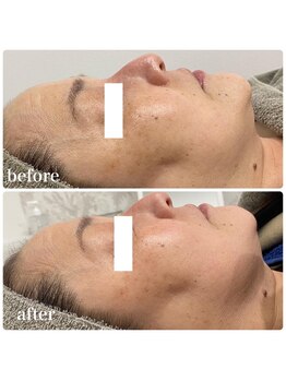 カプリス(CAPRiCE)/BBLフェイシャル