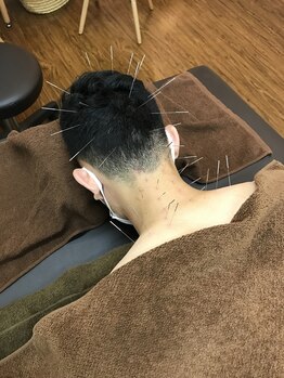 はり処せと/頭痛、首こりへの施術風景