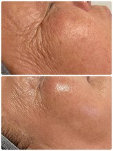 サロンドエテ(salon de ete)/シワ改善でふっくら若見え