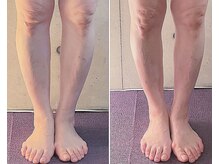 サプナジー(Suppnrgy)/カスタムトリートメント