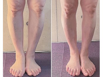 サプナジー(Suppnrgy)/カスタムトリートメント