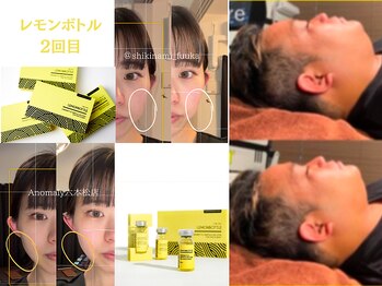 アノマリー 六本松店(Anomaly)/速攻 "小顔" 効果◎レモンボトル