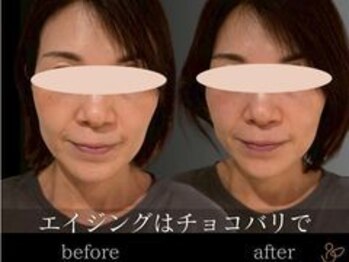 チョコバリ 渋谷店(chocobari)/小顔×リフトアップ(美容鍼)30代