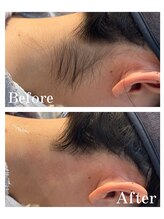 ピュア 川越店/うなじ脱毛