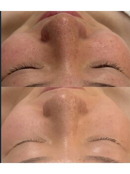 ウィンウィン 新山口店(Win Win)/毛穴ケア