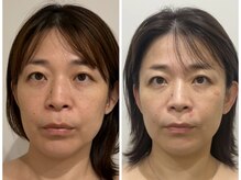 ドクターボディクリスタル(Dr.Body Crystal)の雰囲気（40代　お悩み　フェイスラインのもたつき/余白）