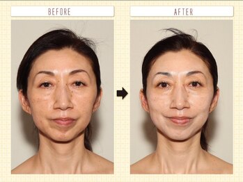 ルクソール/ルビィ陶肌ハーブピーリング