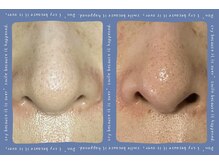 カイユウ(kaiyu)/プラズマフェイシャルエステ