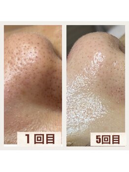 毛穴塾/毛穴の黒ずみ解消