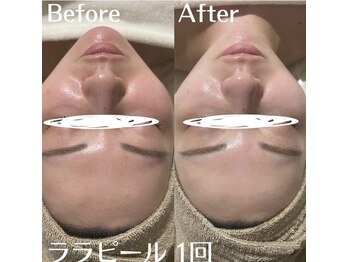 ホワイトアクア 中目黒店(WHITE AQUA)/ララピール/毛穴/美白/中目黒