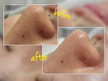 リノ(Lino)/ハイドラ毛穴洗浄