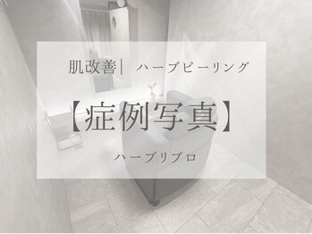 オーパーツ(OOPARTS)/ハーブピーリング/エステ