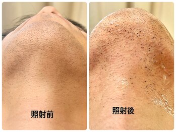 シシエル(CHICIEL)/飛び出すヒゲ脱毛 香里園 脱毛