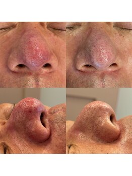 ホロニック ベルサンテ(Holonic Belle Sante)/赤み/毛穴