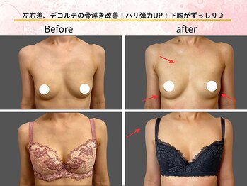 ロットプラス(Lot Plus)/バストアップ症例【E→Fカップ】