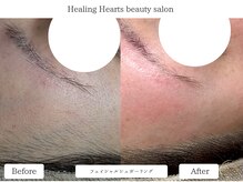 ヒーリングハーツ(Healing Hearts)/フェイスラインスッキリ♪