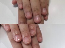 エスネイル(S-nail)/深爪矯正/自爪育成