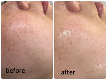 デューン 蕨店(Dune)/ハーブピーリング