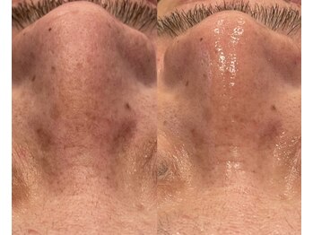 ルナート(Lunart)/毛穴洗浄/毛穴ケア