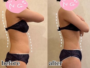 リーインカーナ アーティスト(REINCARNA ARTIST)/【ボディ痩身】上半身変化