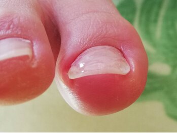 足トラブル専門店  フットケアサロン Nicolulu 春日部店【ニコルル】の写真/【仕上がりが目立たない！】マニキュアも楽しめる特許技術の＜巻き爪補正＞ホームケア方法もお伝えします☆