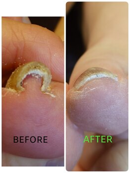 フットスタジオ アルク(FOOT STUDIO ALUK)/【巻き爪補正】ペディグラス