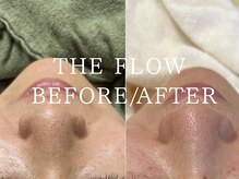 ザ フロウ(THE flow)/毛穴のビフォアアフター
