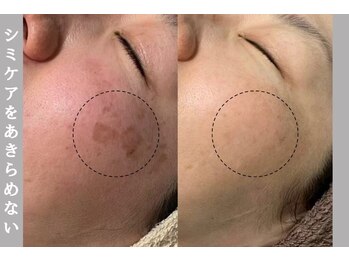 コンフィデンスサロン(Confidence Salon)の写真/【プラズマシャワー&美容液導入で肌のお悩みを根本から改善♪】お肌の内側からうっとり水光肌へ導きます♪