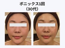 アユアラングレース/30代・1回/まさに「水光肌」誕生