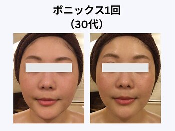 アユアラングレース/30代・1回/まさに「水光肌」誕生