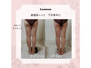 ラエッセス(A Laessess)/部分的ケアも出来る