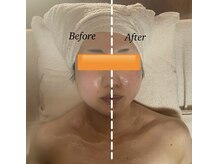 ヴィム(VIM)/ハイパーナイフフェイシャル