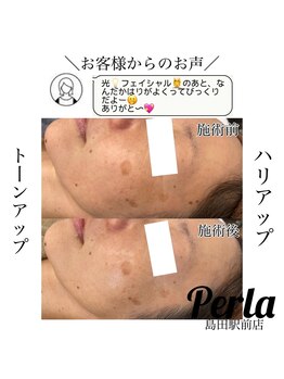 ぺルラ 島田駅前店(Perla)/光フェイシャル