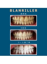 ブランリエ 天王寺阿倍野店(BLANRILLER)/セルフホワイトニング