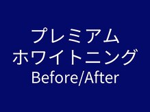ホワイトニングカフェ 岸和田店(WhiteningCafe)/★ホワイトニング効果