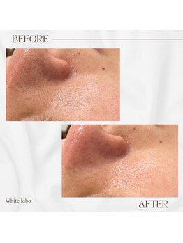 ホワイトラボ 梅田(White labo)/黒ずみ改善でオルチャン美肌☆