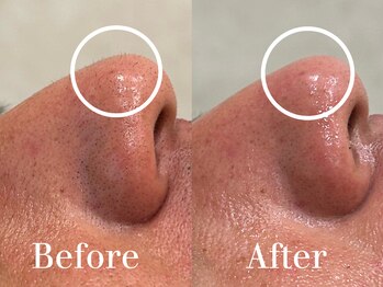 ザ パールズ(The Pearls)/鼻の産毛もスッキリ！