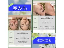 サロンド ベレーゼの雰囲気（一番の推しはハーバルモアピーリングですbefore&afterです。）