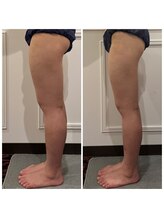 心斎橋 ルヴィ(REVI)/脚太もも/下半身/痩身ダイエット