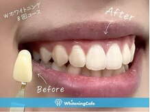 ホワイトニングカフェ 豊中店(WhiteningCafe)/◎歯のホワイトニング施術写真◎