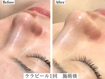 フレイヤ(FREYA)/ララピールBefore→After