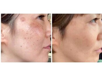 モエ ビューティーサロン(moe Beauty Salon)/次世代シミ改善フォト