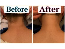 トータルビューティーサロン 凛/全身の脱毛