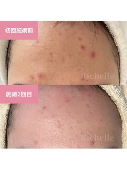 リシェル(Richelle)/ 【GREENPEELポアーズ】