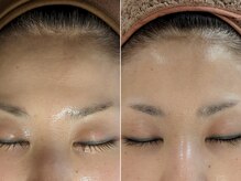 ミューク 自由が丘(mjuk)/セルラムでおでこのシワ改善