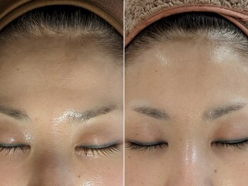 ミューク 自由が丘(mjuk)/セルラムでおでこのシワ改善