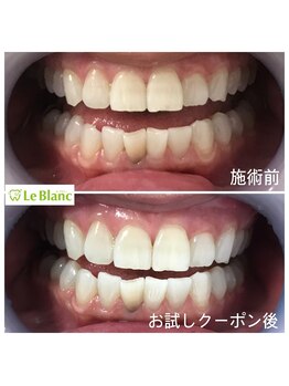 ルブラン 奈良店(Le Blanc)/家族でホワイトニング!!って