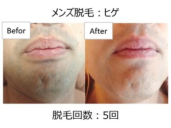オワゾーブルー(Oiseaubleu)/【メンズ】ヒゲ脱毛5回目