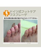 フスフレーゲ 学芸大学店/足爪の魚の目のお悩み