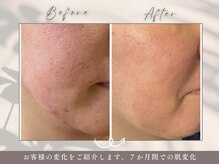 碧(ao)/肌質改善